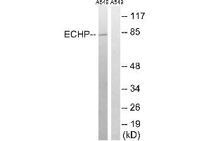Immunohistochemistry analysis of paraffin-embedded human breast carcinoma tissue using EHHADH antibody. (EHHADH anticorps  (Internal Region))