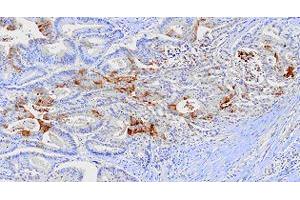 Paraffin embedded sections of human colon cancer tissue were incubated with FABP1 monoclonal antibody, clone 2G4  (1:100).