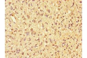 Immunohistochemistry of paraffin-embedded human glioma using ABIN7169250 at dilution of 1:100