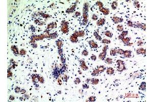 Immunohistochemistry (IHC) analysis of paraffin-embedded Human Breast Cancer, antibody was diluted at 1:200. (BMP2 anticorps  (Internal Region))