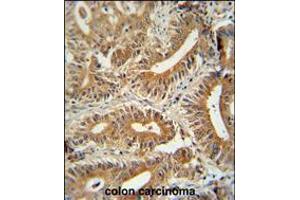 CCDC123 antibody immunohistochemistry analysis in formalin fixed and paraffin embedded human colon carcinoma followed by peroxidase conjugation of the secondary antibody and DAB staining. (CEP89 anticorps  (C-Term))