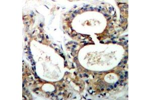 Immunohistochemistry of paraffin-embedded Human breast carcinoma using Phospho-PTPN11(Y542) Polyclonal Antibody