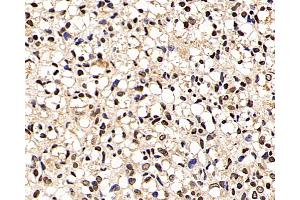 Immunohistochemistry analysis of paraffin-embedded human liver cancer using p27 Polyclonal Antibody at dilution of 1:200. (CDKN1B anticorps)