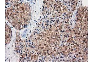 Immunohistochemical staining of paraffin-embedded Adenocarcinoma of Human breast tissue using anti-DSTN mouse monoclonal antibody. (Destrin anticorps)