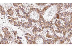 ABIN6279259 at 1/100 staining Human liver cancer tissue by IHC-P. (CEACAM20 anticorps  (Internal Region))