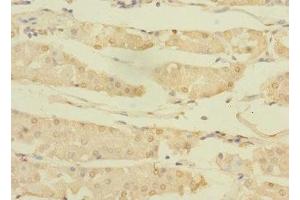 Immunohistochemistry of paraffin-embedded human gastric cancer using ABIN7144765 at dilution of 1:100