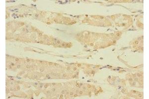 Immunohistochemistry of paraffin-embedded human gastric cancer using ABIN7144765 at dilution of 1:100 (ASTL anticorps  (AA 38-337))