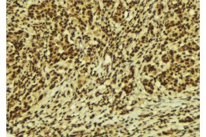 ABIN6269320 at 1/100 staining Human breast cancer tissue by IHC-P. (c-Rel anticorps  (Internal Region))