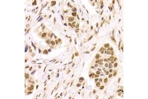Immunohistochemistry of paraffin-embedded human breast cancer using HMGB1 Antibody. (HMGB1 anticorps  (AA 100-200))