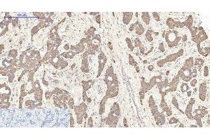 Immunohistochemistry of paraffin-embedded Human liver cancer tissue using NFKBIB Monoclonal Antibody at dilution of 1:200. (NFKBIB anticorps)