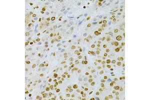 Immunohistochemistry of paraffin-embedded human liver cancer using DKC1 Antibody (ABIN5970956) at dilution of 1/200 (40x lens). (DKC1 anticorps)