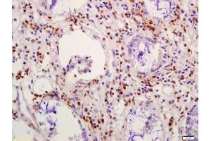 Formalin-fixed and paraffin embedded human colon carcinoma labeled with Anti-NFAT4 Polyclonal Antibody, Unconjugated (ABIN872596) at 1:200 followed by conjugation to the secondary antibody and DAB staining