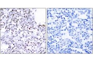 Immunohistochemistry analysis of paraffin-embedded human breast carcinoma tissue, using SMC1 (Ab-957) Antibody. (SMC1A anticorps  (AA 931-980))