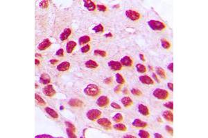 Immunohistochemical analysis of HOXC6 staining in human prostate cancer formalin fixed paraffin embedded tissue section.