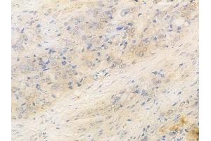 ABIN6266061 and ABIN6269302 at 1/100 staining human prostate carcinoma by IHC-P.