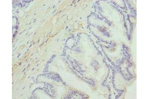 Immunohistochemistry of paraffin-embedded human prostate cancer using ABIN7149844 at dilution of 1:100 (DGKA anticorps  (AA 1-200))
