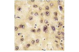 IHC analysis of FFPE human hepatocarcinoma tissue stained with PROX1 antibody