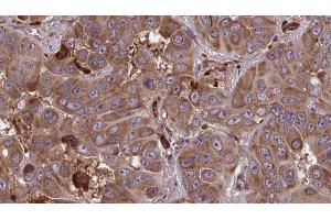 ABIN6273858 at 1/100 staining Human liver cancer tissue by IHC-P. (GPR161 anticorps  (Internal Region))