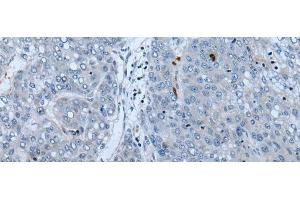 Immunohistochemistry of paraffin-embedded Human liver cancer tissue using NF1 Polyclonal Antibody at dilution of 1:65(x200) (Neurofibromin 1 anticorps)