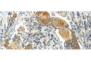 Immunohistochemistry of paraffin-embedded Human cervical cancer using MSI1 Polyclonal Antibody at dilution of 1/30 (MSI1 anticorps)