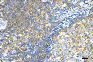 Immunohistochemistry was performed on paraffin-embedded human breast carcinoma using moesin antibody (ABIN7799482), 1:200). (Recombinant Moesin anticorps)