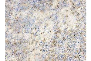 ABIN6256507 and ABIN6267633 at 1/100 staining human melanoma by IHC-P.