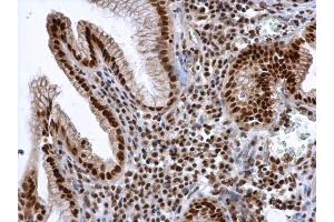 IHC-P Image ALY antibody detects ALY protein at nucleus in human esophageal cancer by immunohistochemical analysis. (THO Complex 4 anticorps)