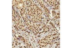 Immunohistochemical analysis of XRCC4 staining in human breast cancer formalin fixed paraffin embedded tissue section. (XRCC4 anticorps)