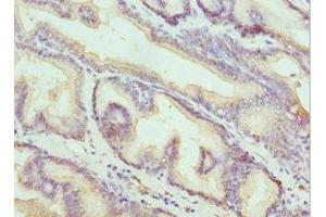Immunohistochemistry of paraffin-embedded human prostate cancer using ABIN7157199 at dilution of 1:100