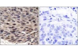 Immunohistochemistry analysis of paraffin-embedded human breast carcinoma, using 4E-BP1 (Phospho-Thr36) Antibody.