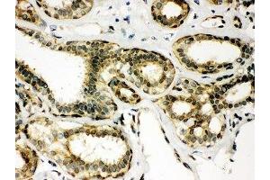 IHC-P: Peroxiredoxin 6 antibody testing of human breast cancer tissue