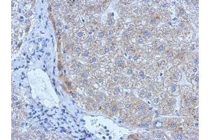 IHC-P Image tPA antibody detects PLAT protein at cytosol on human hepatoma by immunohistochemical analysis.