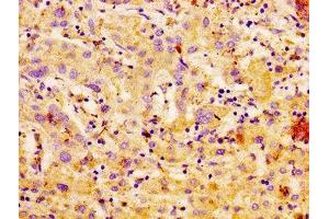 IHC image of ABIN7146723 diluted at 1:100 and staining in paraffin-embedded human liver cancer performed on a Leica BondTM system. (CA4 anticorps  (AA 75-200))