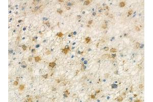 ABIN7093972 and ABIN7098016 at 1/100 staining human astrocytoma by IHC-P.