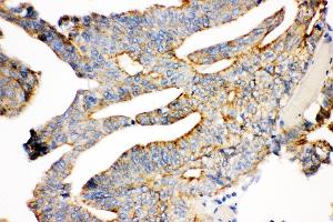 Anti- gamma Catenin Picoband antibody, IHC(P) IHC(P): Human Intestinal Cancer Tissue