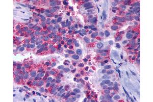 Anti-GPR137B antibody IHC of human Ovary, Carcinoma. (GPR137B anticorps  (Cytoplasmic Domain))