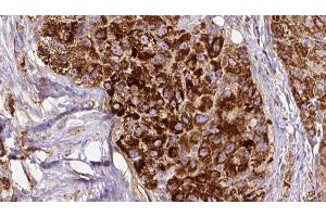 ABIN6272677 at 1/100 staining Human liver cancer tissue by IHC-P. (Calcitonin Receptor anticorps  (N-Term))