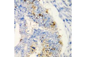 Immunohistochemistry of paraffin-embedded human colon carcinoma using TIRAP antibody at dilution of 1:200 (40x lens). (TIRAP anticorps)