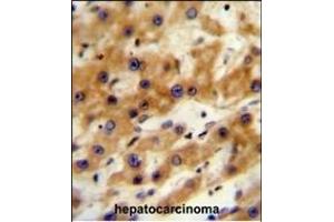 GAGE13 Antibody (N-term) (ABIN654525 and ABIN2844247) immunohistochemistry analysis in formalin fixed and paraffin embedded human hepatocarcinoma followed by peroxidase conjugation of the secondary antibody and DAB staining. (G Antigen 13 anticorps  (N-Term))