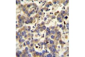 Immunohistochemistry analysis in formalin fixed and paraffin embedded human testis carcinoma reacted with  LYPD4 Antibody (Center) followed which was peroxidase conjugated to the secondary antibody and followed by DAB staining. (LYPD4 anticorps  (Middle Region))