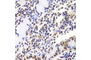 Immunohistochemistry of paraffin-embedded human gastric cancer using XRCC5 Antibody. (XRCC5 anticorps)