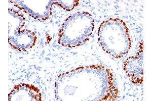 Formalin-fixed, paraffin-embedded human Prostate Carcinoma stained with p40 Rabbit Polyclonal Antibody. (p63 anticorps  (AA 5-17))