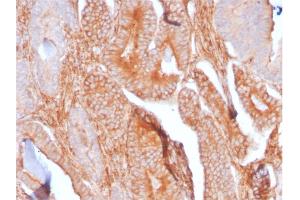 Formalin-fixed, paraffin-embedded human Prostate Carcinoma stained with CD81 Rabbit Recombinant Monoclonal Antibody (C81/2885R). (Recombinant CD81 anticorps)