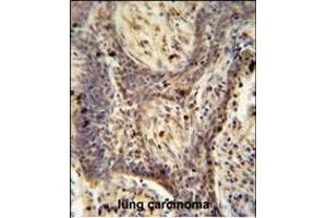 RC1 antibody (C-term) (ABIN654964 and ABIN2844603) immunohistochemistry analysis in formalin fixed and paraffin embedded human lung carcinoma followed by peroxidase conjugation of the secondary antibody and DAB staining.