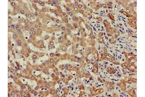 Immunohistochemistry of paraffin-embedded human liver cancer using ABIN7171195 at dilution of 1:100 (SDC4 anticorps  (AA 19-145))