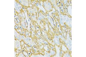 Immunohistochemistry of paraffin-embedded human liver cancer using TGFBI antibody.