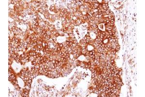 IHC-P Image Immunohistochemical analysis of paraffin-embedded human endometrial cancerrcinoma, using HSP90 beta, antibody at 1:100 dilution.