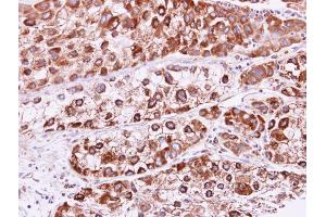 IHC-P Image RAB2B antibody detects RAB2B protein at cytoplasm and membrane on human liver carcinoma by immunohistochemical analysis.