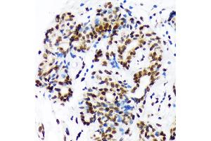 Immunohistochemistry of paraffin-embedded human breast cancer using DEK Rabbit mAb (ABIN7266724) at dilution of 1:100 (40x lens).