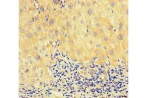 Immunohistochemistry of paraffin-embedded human liver cancer using ABIN7150287 at dilution of 1:100